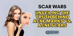 Read more about the article Acne Marks vs Acne Scars: Decoding Differences for Clear Skin