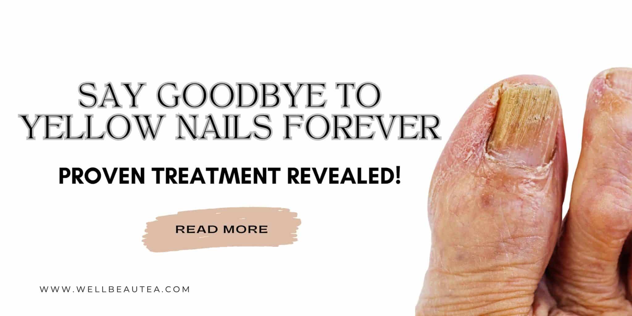 Read more about the article Yellow Nail Syndrome Treatment: Top Solutions for Healthier Nails