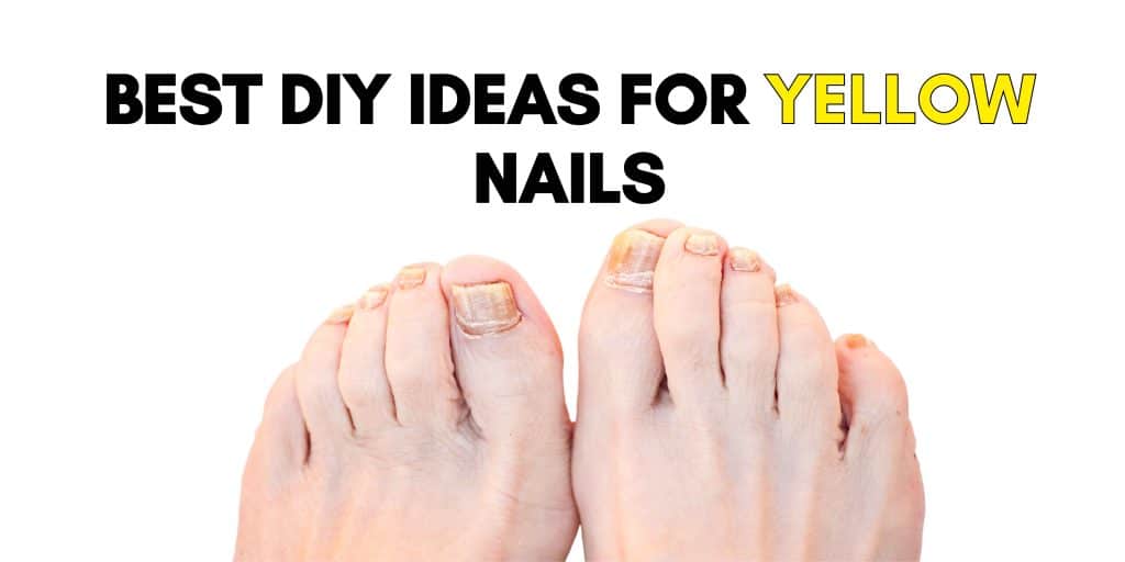 Yellow nail syndrome treatment